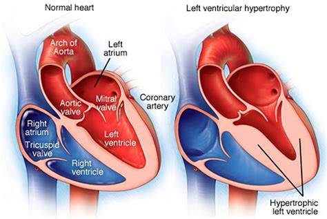 Left ventricular hypertrophy 